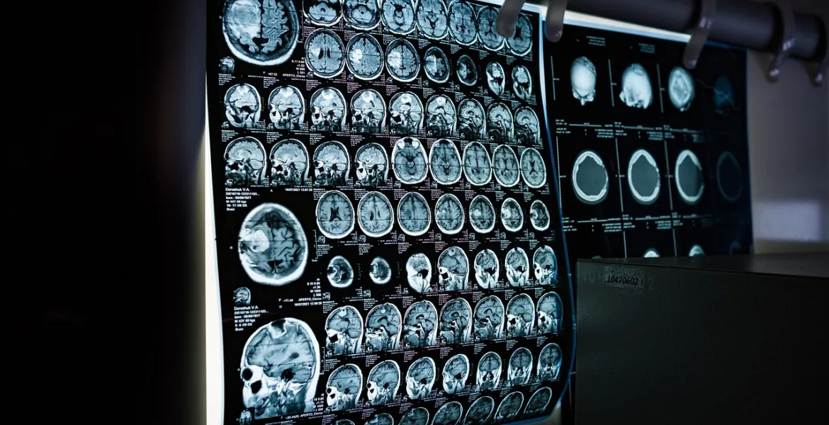 Neuralink svela un futuro oltre la realtà: Impianto fa 'Vedere' scimmie