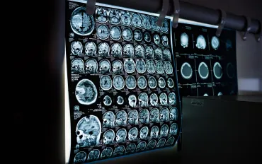 Neuralink svela un futuro oltre la realtà: Impianto fa 'Vedere' scimmie