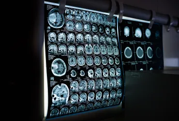 Neuralink svela un futuro oltre la realtà: Impianto fa 'Vedere' scimmie
