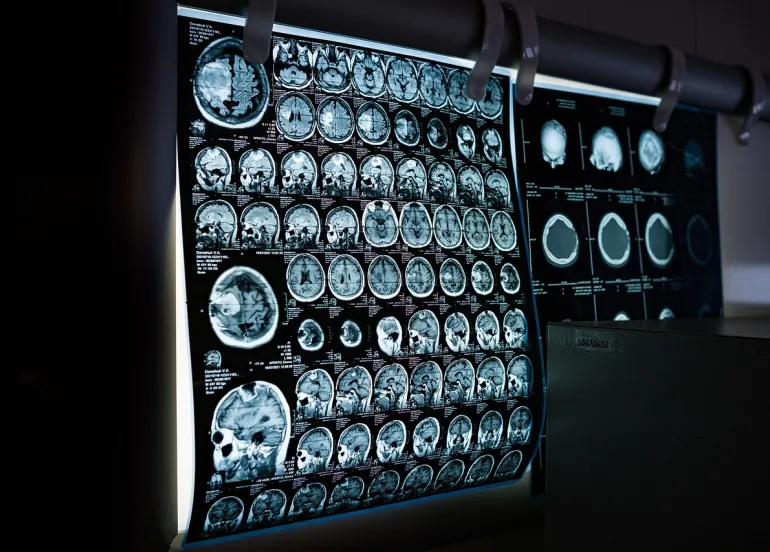 Neuralink svela un futuro oltre la realtà: Impianto fa 'Vedere' scimmie